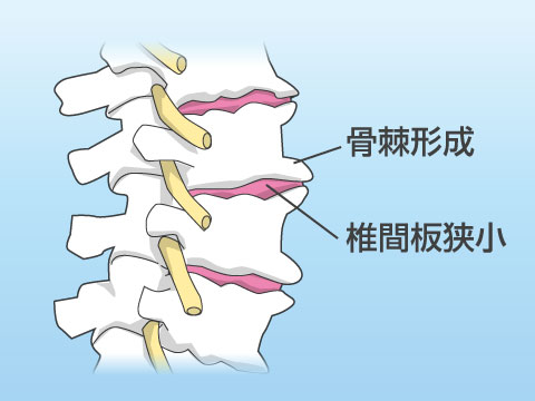 腰部脊椎症