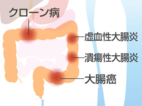 腸疾患